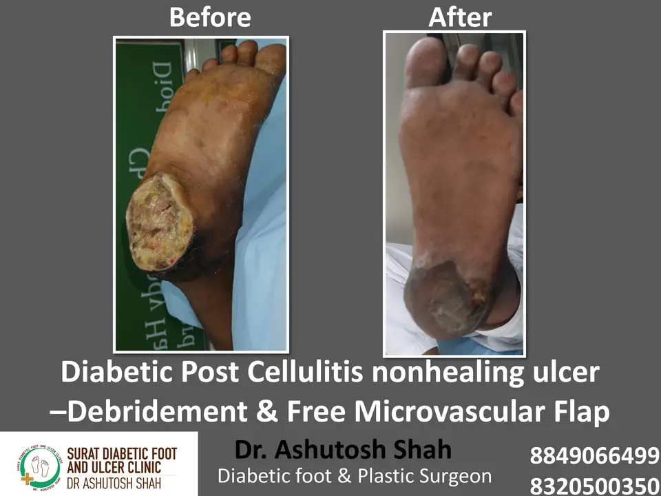 Diabetic Foot  PPT sunita.pptx-5.webp